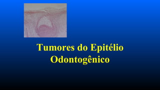 Tumores do Epitélio
Odontogênico
 