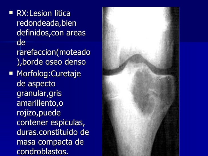 Tumores oseos