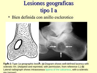 Lesiones geograficasLesiones geograficas
tipo I atipo I a
• Bien definida con anillo esclerotico
Figure 3: Type 1a geographic lesion. (a) Diagram shows well-defined lucency with
sclerotic rim. (Adapted and reprinted, with permission, from reference 1.) (b)
Lateral radiograph shows intraosseous lipoma of the calcaneus, with a sclerotic
 