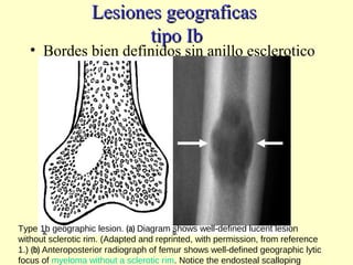 Lesiones geograficasLesiones geograficas
tipo Ibtipo Ib
• Bordes bien definidos sin anillo esclerotico
Type 1b geographic lesion. (a) Diagram shows well-defined lucent lesion
without sclerotic rim. (Adapted and reprinted, with permission, from reference
1.) (b) Anteroposterior radiograph of femur shows well-defined geographic lytic
focus of myeloma without a sclerotic rim. Notice the endosteal scalloping
 