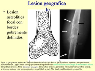• Lesion
osteolitica
focal con
bordes
pobremente
definidos
Type 1c geographic lesion. (a) Diagram shows ill-defined lytic lesion. (Adapted and reprinted,with permission,
from reference 1.) (b) Lateral radiograph of femur in patient with osteosarcoma shows large ill-defined lytic lesion
(large black arrows). Note Codman trianglesCodman triangles (large white arrows), periosteal interruption (small white arrow),
and tumor-induced new bone production (small black arrow). The diaphyseal location is unusual for
Lesion geograficaLesion geografica
IcIc
 