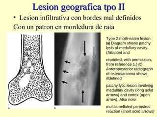 Lesion geografica tpo IILesion geografica tpo II
• Lesion infiltrativa con bordes mal definidos
Con un patron en mordedura de rata
Type 2 moth-eaten lesion.
(a) Diagram shows patchy
lysis of medullary cavity.
(Adapted and
reprinted, with permission,
from reference 1.) (b)
Anteroposterior radiograph
of osteosarcoma shows
illdefined
patchy lytic lesion involving
medullary cavity (long solid
arrows) and cortex (open
arrow). Also note
multilamellated periosteal
reaction (short solid arrows)
 