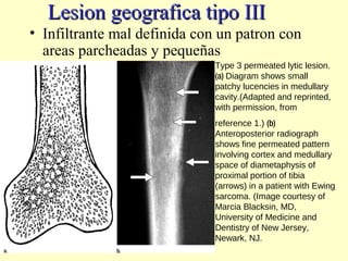 Lesion geografica tipo IIILesion geografica tipo III
• Infiltrante mal definida con un patron con
areas parcheadas y pequeñas
Type 3 permeated lytic lesion.
(a) Diagram shows small
patchy lucencies in medullary
cavity.(Adapted and reprinted,
with permission, from
reference 1.) (b)
Anteroposterior radiograph
shows fine permeated pattern
involving cortex and medullary
space of diametaphysis of
proximal portion of tibia
(arrows) in a patient with Ewing
sarcoma. (Image courtesy of
Marcia Blacksin, MD,
University of Medicine and
Dentistry of New Jersey,
Newark, NJ.
 