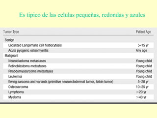 Es tipico de las celulas pequeñas, redondas y azules
.
 