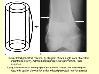 Unilamellated periosteal reaction. (a) Diagram shows single layer of reactive
periosteum (arrow).(Adapted and reprinted, with permission, from
reference
2.) (b) Anteroposterior radiograph of the knee in patient with hypertrophic
osteoarthropathy shows thick unilamellated periosteal reaction (arrows
 