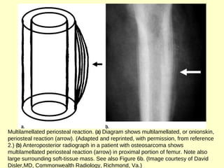 Multilamellated periosteal reaction. (a) Diagram shows multilamellated, or onionskin,
periosteal reaction (arrow). (Adapted and reprinted, with permission, from reference
2.) (b) Anteroposterior radiograph in a patient with osteosarcoma shows
multilamellated periosteal reaction (arrow) in proximal portion of femur. Note also
large surrounding soft-tissue mass. See also Figure 6b. (Image courtesy of David
Disler,MD, Commonwealth Radiology, Richmond, Va.)
 