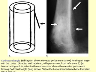Codman triangleCodman triangle. (a) Diagram shows elevated periosteum (arrow) forming an angle
with the cortex. (Adapted and reprinted, with permission, from reference 2.) (b)
Lateral radiograph in patient with osteosarcoma shows the elevated periosteum
forming Codman triangle (long arrow). Notice the tumor-induced new bone formation
 