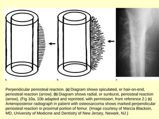 Perpendicular periosteal reaction. (a) Diagram shows spiculated, or hair-on-end,
periosteal reaction (arrow). (b) Diagram shows radial, or sunburst, periosteal reaction
(arrow). (Fig 10a, 10b adapted and reprinted, with permission, from reference 2.) (c)
Anteroposterior radiograph in patient with osteosarcoma shows marked perpendicular
periosteal reaction in proximal portion of femur. (Image courtesy of Marcia Blacksin,
MD, University of Medicine and Dentistry of New Jersey, Newark, NJ.)
 
