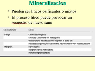 MineralizacionMineralizacion
• Pueden ser liticos osificantes o mixtos
• El proceso litico puede provocar un
secuestro de hueso sano
 