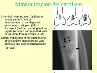 Mineralizacion del cartilago
Chondral mineralization. (a) Diagram
shows patterns and of
mineralization of cartilaginous
tumor matrix: stippled (left),
flocculent (middle), and ring and arc
(right). (Adapted and reprinted, with
permission, from reference 3.) (b)
Lateral radiograph of proximal portion
of tibia shows enchondroma with
punctate and arclike mineralization
( arrows)
 