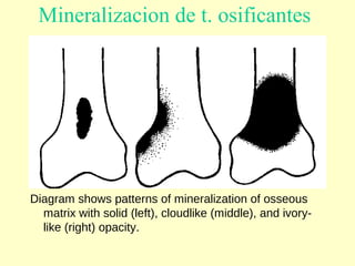 Mineralizacion de t. osificantes
Diagram shows patterns of mineralization of osseous
matrix with solid (left), cloudlike (middle), and ivory-
like (right) opacity.
 