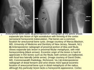 Aneurysmal bone cysts. (a) Anteroposterior radiograph of the pelvis shows
expansile lytic lesion of right acetabulum with thinning of the cortex
(arrow)and honeycomb trabeculation. Flat bones are a common
location for aneurysmal bone cysts. (Image courtesy of Marcia Blacksin,
MD, University of Medicine and Dentistry of New Jersey, Newark, NJ.)
(b) Anteroposterior radiograph of proximal portion of tibia and fibula
shows expansile lytic lesion in proximal fibular metaphysis, with mild
honeycombing (black arrows). Eccentric origin of the lesion is hard to
appreciate in thin bones such as the fibula; both cortices are ballooned,
with focal loss laterally (white arrow). (Image courtesy of David Disler,
MD, Commonwealth Radiology, Richmond, Va.) (c) Anteroposterior
radiograph of distal forearm and wrist shows more typical eccentric
location of aneurysmal bone cyst in distal metaphysis of the radius,
although this particular lesion lacks a honeycomb appearance. Cortex
 