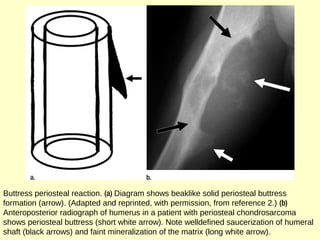 Buttress periosteal reaction. (a) Diagram shows beaklike solid periosteal buttress
formation (arrow). (Adapted and reprinted, with permission, from reference 2.) (b)
Anteroposterior radiograph of humerus in a patient with periosteal chondrosarcoma
shows periosteal buttress (short white arrow). Note welldefined saucerization of humeral
shaft (black arrows) and faint mineralization of the matrix (long white arrow).
 
