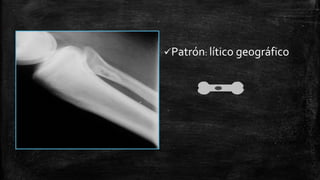 Comprehensive Overview of Bone Tumors: Classification, Imaging, and ...