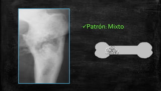 Comprehensive Overview of Bone Tumors: Classification, Imaging, and ...