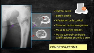 Comprehensive Overview of Bone Tumors: Classification, Imaging, and ...