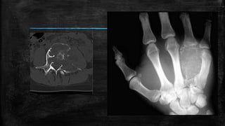Comprehensive Overview of Bone Tumors: Classification, Imaging, and ...