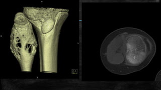 Comprehensive Overview of Bone Tumors: Classification, Imaging, and ...