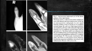 Comprehensive Overview of Bone Tumors: Classification, Imaging, and ...