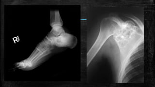 Comprehensive Overview of Bone Tumors: Classification, Imaging, and ...