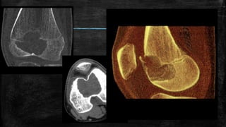 Comprehensive Overview of Bone Tumors: Classification, Imaging, and ...