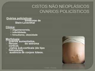 Ovários policísticos:
Síndrome de
Stein-Leventhal
Clínica:
 oligomenorreia,
 infertilidade,
 hirsutismo, obesidade
Morfologia:
 ovários aumentados,
 fibrose do estroma
cortical,
 cistos sub-corticais (do tipo
foliculares),
 ausência de corpos lúteos.
Chirlei A Ferreira
 