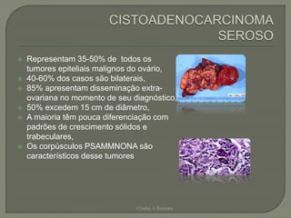  Representam 35-50% de todos os
tumores epiteliais malignos do ovário,
 40-60% dos casos são bilaterais,
 85% apresentam disseminação extra-
ovariana no momento de seu diagnóstico,
 50% excedem 15 cm de diâmetro,
 A maioria têm pouca diferenciação com
padrões de crescimento sólidos e
trabeculares,
 Os corpúsculos PSAMMNONA são
característicos desse tumores
Chirlei A Ferreira
 