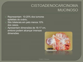  Representam 10-20% dos tumores
epiteliais do ovário,
 São bilaterais em pelo menos 10%
dos casos,
 Apresentam dimensões de 16-17 cm,
embora podem alcançar imensas
dimensões
Chirlei A Ferreira
 