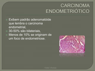  Exibem padrão adenomatóide
que lembra o carcinoma
endometrial,
 30-50% são bilateriais,
 Menos de 10% se originam de
um foco de endometriose.
Chirlei A Ferreira
 