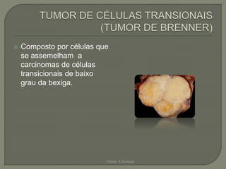  Composto por células que
se assemelham a
carcinomas de células
transicionais de baixo
grau da bexiga.
Chirlei A Ferreira
 