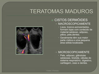  CISTOS DERMÓIDES
• MACROSCOPICAMENTE
 Lisos, branco-acinzentados,
formam lojas com conteúdo de
material sebáceo, adiposo,
pêlos, pele,dentes.
 Geralmente têm sua maior
parte cística e uma pequena
área sólida localizada.
• MICROSCOPICAMENTE
 Pele, adiposo, glândulas
sebáceas, tireóide, células do
sistema respiratório, digestivo,
cartilagem, osso e dentes.
Chirlei A Ferreira
 