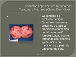 -  Geralmente de
evolução benigna,
 Quando observamos
presença de tecidos
tireoidiano chamamos
de “struma-ovari”,
 A malignização ocorre
formando coarcinomas
epidermóide ou
melanomas a partir de
um tumor de pele.
Chirlei A Ferreira
 