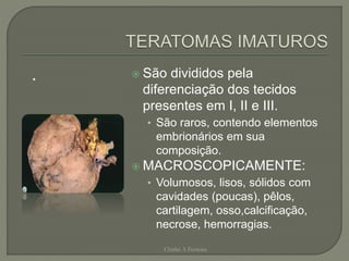 .  São divididos pela
diferenciação dos tecidos
presentes em I, II e III.
• São raros, contendo elementos
embrionários em sua
composição.
 MACROSCOPICAMENTE:
• Volumosos, lisos, sólidos com
cavidades (poucas), pêlos,
cartilagem, osso,calcificação,
necrose, hemorragias.
Chirlei A Ferreira
 