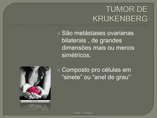  São metástases ovarianas
bilaterais , de grandes
dimensões mais ou menos
simétricos,
 Composto pro células em
“sinete” ou “anel de grau”
Chirlei A Ferreira
 