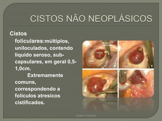 Cistos
foliculares:múltiplos,
uniloculados, contendo
líquido seroso, sub-
capsulares, em geral 0,5-
1,0cm.
Extremamente
comuns,
correspondendo a
folículos atresicos
cistificados.
Chirlei A Ferreira
 