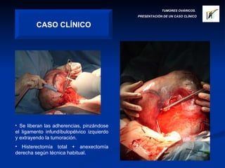 TUMORES OVÁRICOS.  PRESENTACIÓN DE UN CASO CLÍNICO CASO CLÍNICO Se liberan las adherencias, pinzándose el ligamento infundíbulopélvico izquierdo y extrayendo la tumoración. Histerectomía total + anexectomía derecha según técnica habitual. 