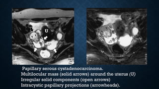  Papillary serous cystadenocarcinoma.
Multilocular mass (solid arrows) around the uterus (U)
Irregular solid components (open arrows)
Intracystic papillary projections (arrowheads).
 