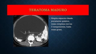 TERATOMA MADUROTERATOMA MADURO
• Amplio espectro desdeAmplio espectro desde
puramente quístico,puramente quístico,
masa compleja con losmasa compleja con los
3 componentes, hasta3 componentes, hasta
masa grasa.masa grasa.
 