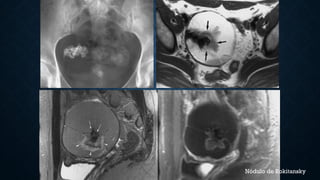 Nódulo de Rokitansky
 