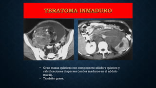TERATOMA INMADUROTERATOMA INMADURO
• Gran masas quísticas con componente sólido y quístico y
calcificaciones dispersas ( en los maduros en el nódulo
mural).
• También grasa.
 
