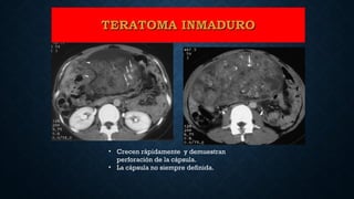 • Crecen rápidamente y demuestran
perforación de la cápsula.
• La cápsula no siempre definida.
TERATOMA INMADUROTERATOMA INMADURO
 