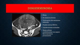 DISGERMINOMADISGERMINOMA
• Raros.Raros.
• En mujeres jóvenes.En mujeres jóvenes.
• Contraparte del seminomaContraparte del seminoma
testicular.testicular.
• Pueden elevar HCG-b.Pueden elevar HCG-b.
• Calcificaciones moteadas.Calcificaciones moteadas.
• Masas sólidasMasas sólidas
multilobuladas con septosmultilobuladas con septos
fibrovascularesfibrovasculares
prominentes.prominentes.
 