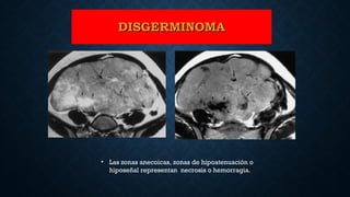 • Las zonas anecoicas, zonas de hipoatenuación o
hiposeñal representan necrosis o hemorragia.
DISGERMINOMADISGERMINOMA
 