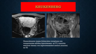 KRUKENBERGKRUKENBERG
Generalmente masas bilaterales complejas con
componentes sólidos hipointensos en T1( reacción
estromal densa) con hiperintensidad central (mucina)
en T2
 