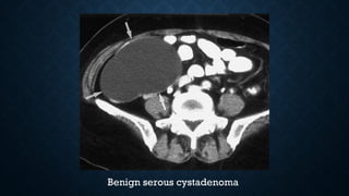 Benign serous cystadenoma
 