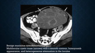 Benign mucinous cystadenoma.
Multilocular cystic mass (arrows) with a smooth contour, honeycomb
appearance, and heterogeneous attenuation in the locules
 