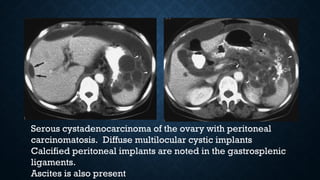 Serous cystadenocarcinoma of the ovary with peritoneal
carcinomatosis. Diffuse multilocular cystic implants
Calcified peritoneal implants are noted in the gastrosplenic
ligaments.
Ascites is also present
 