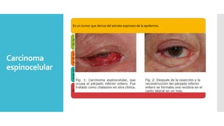 Tumores Palpebrales Pptx 