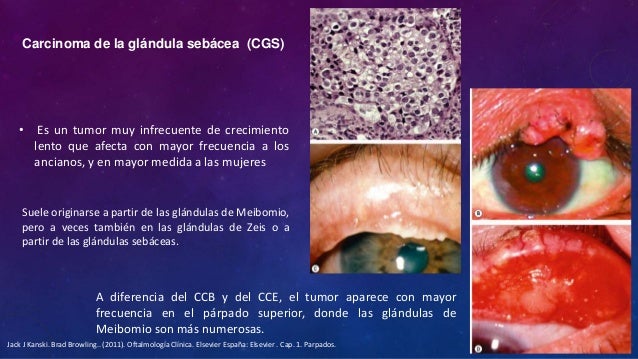 El Cancer En Ancianos Es Mas Lento