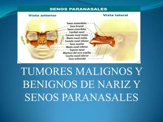 TUMORES MALIGNOS Y
BENIGNOS DE NARIZ Y
 SENOS PARANASALES
 